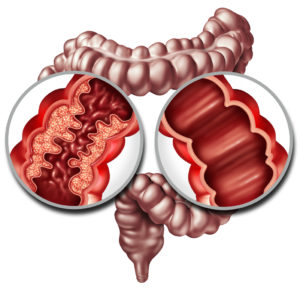 close up of a human intestine with inflammation symptoms causing obstruction as a 3D illustration.