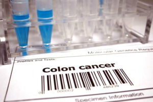 Colon Cancer